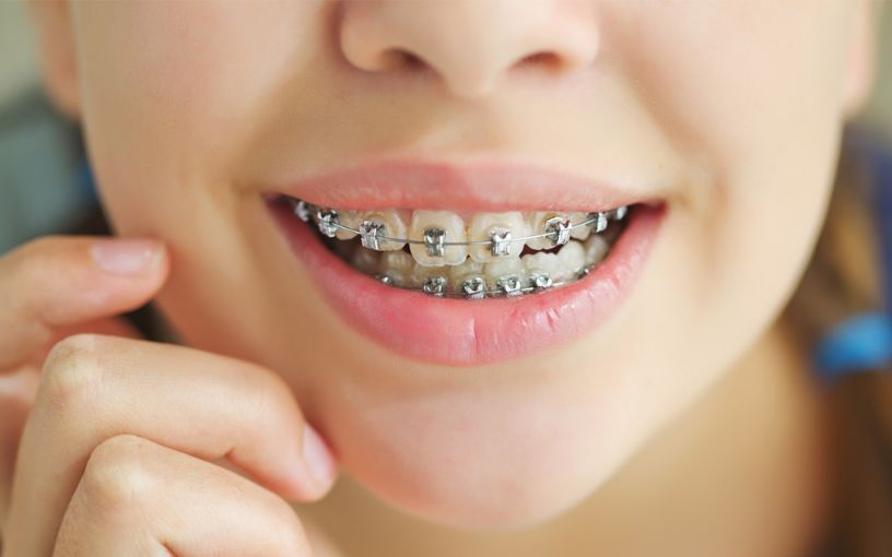 Braces Treatment in Madurai