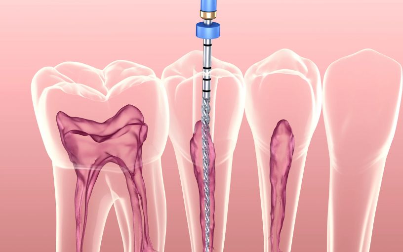 Root Canal Treatment in Madurai: What to Expect and How to Prepare