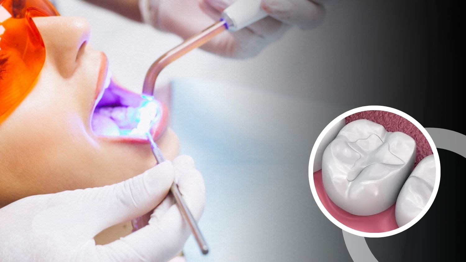 	Dental Filling