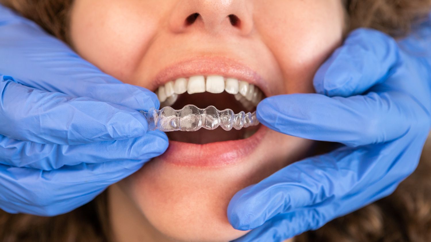 Invisible Braces for Teeth Alignment in Ramanathapuram 