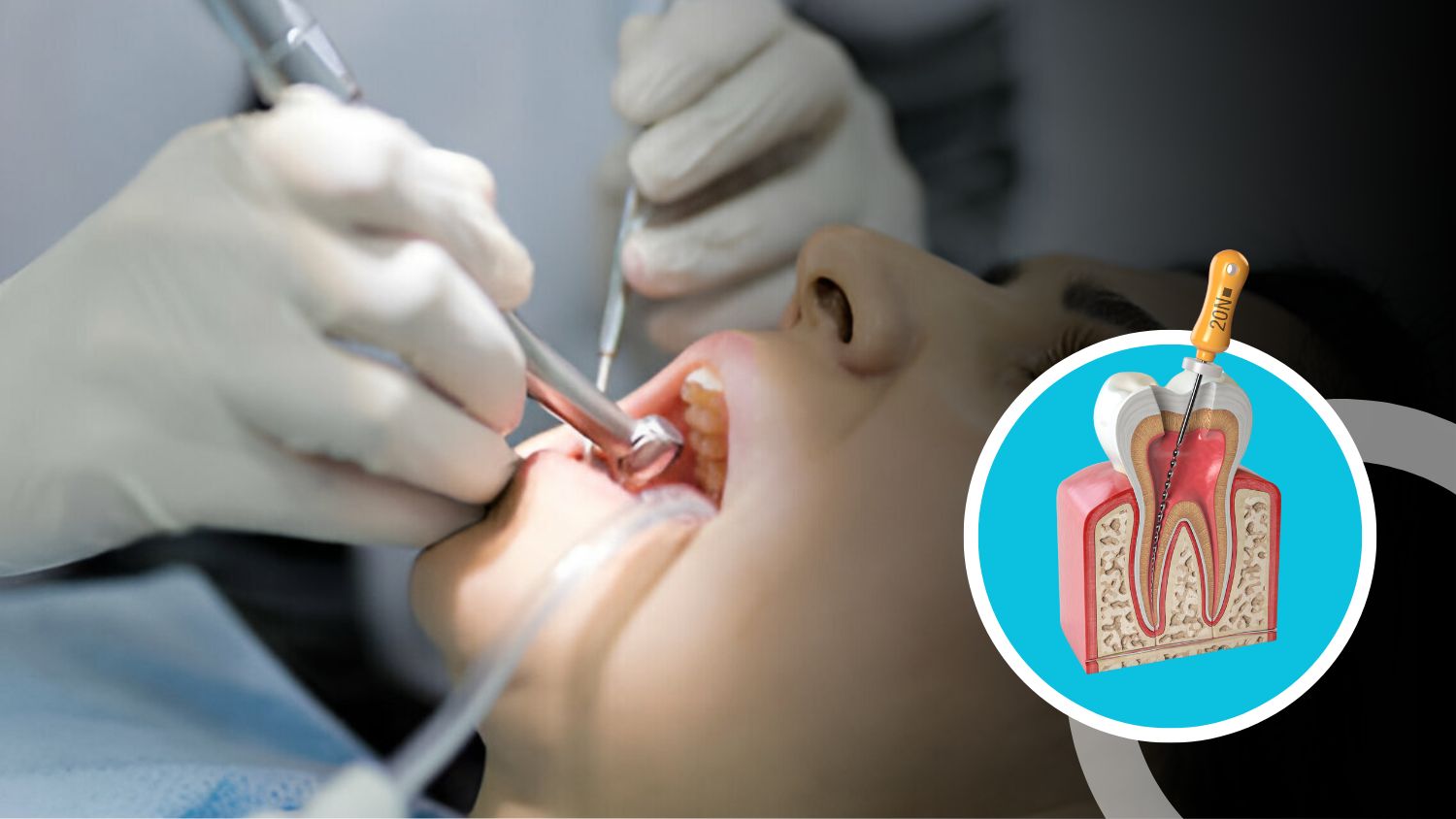 Root Canal Treatment in Madurai: Finding the Best Dental Clinic in Madurai