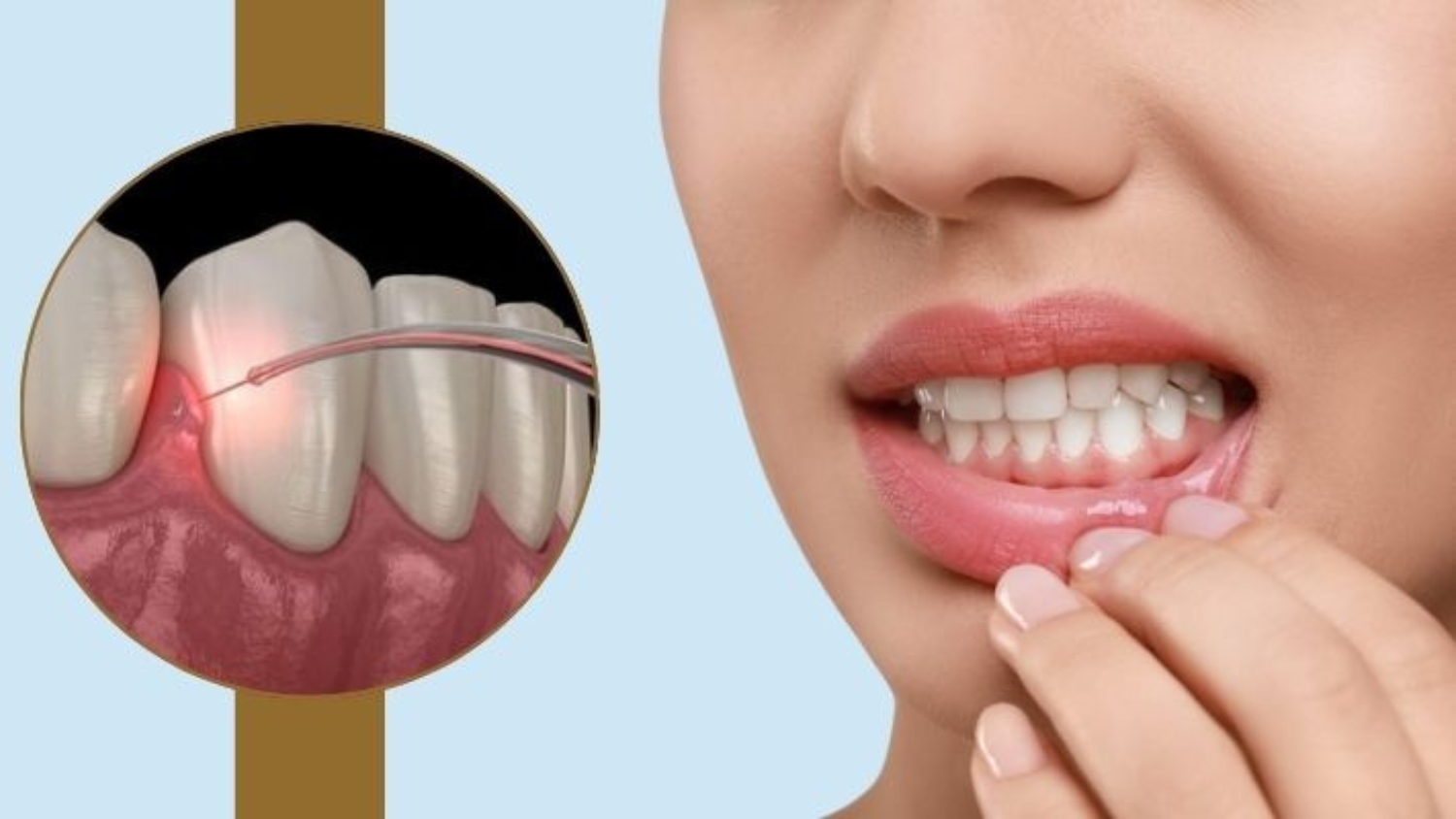 Laser Gum Depigmentation – SRM Dental Clinic