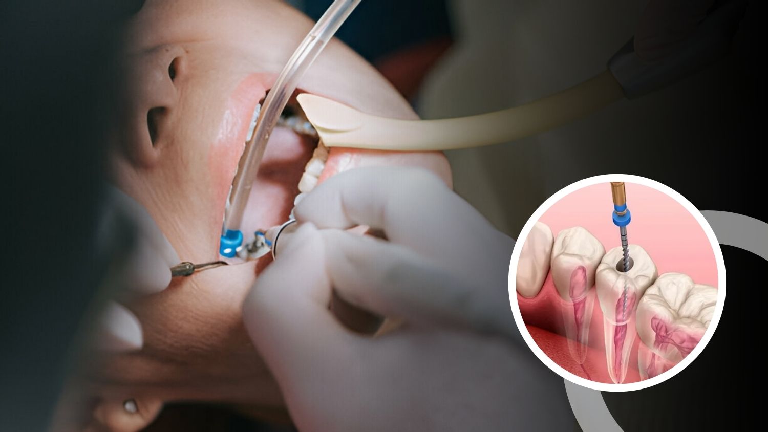 Root Canal Treatment in Madurai: A Complete Guide