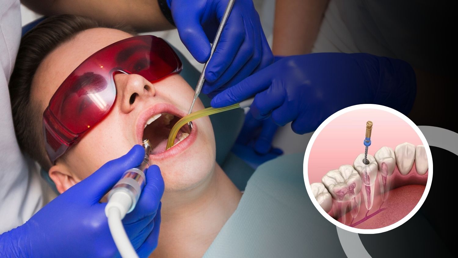 Root Canals in Madurai