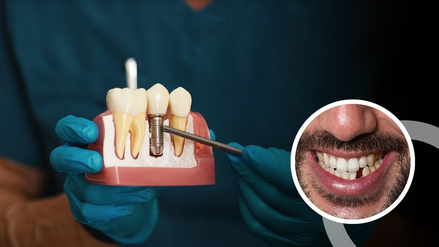 Single Tooth Implant Cost in Madurai