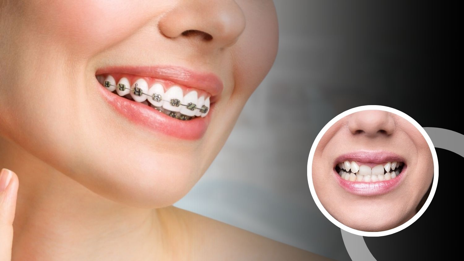 Dental Crown and Bridge Treatment in Madurai