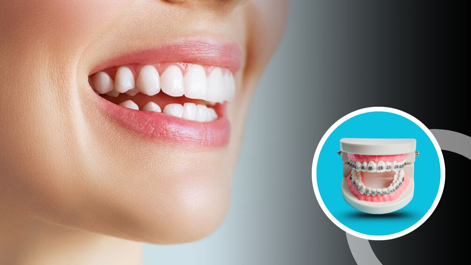 Teeth Alignment Treatment in Madurai 