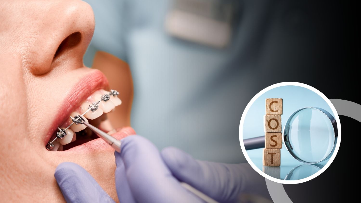Teeth Braces Cost in Madurai 
