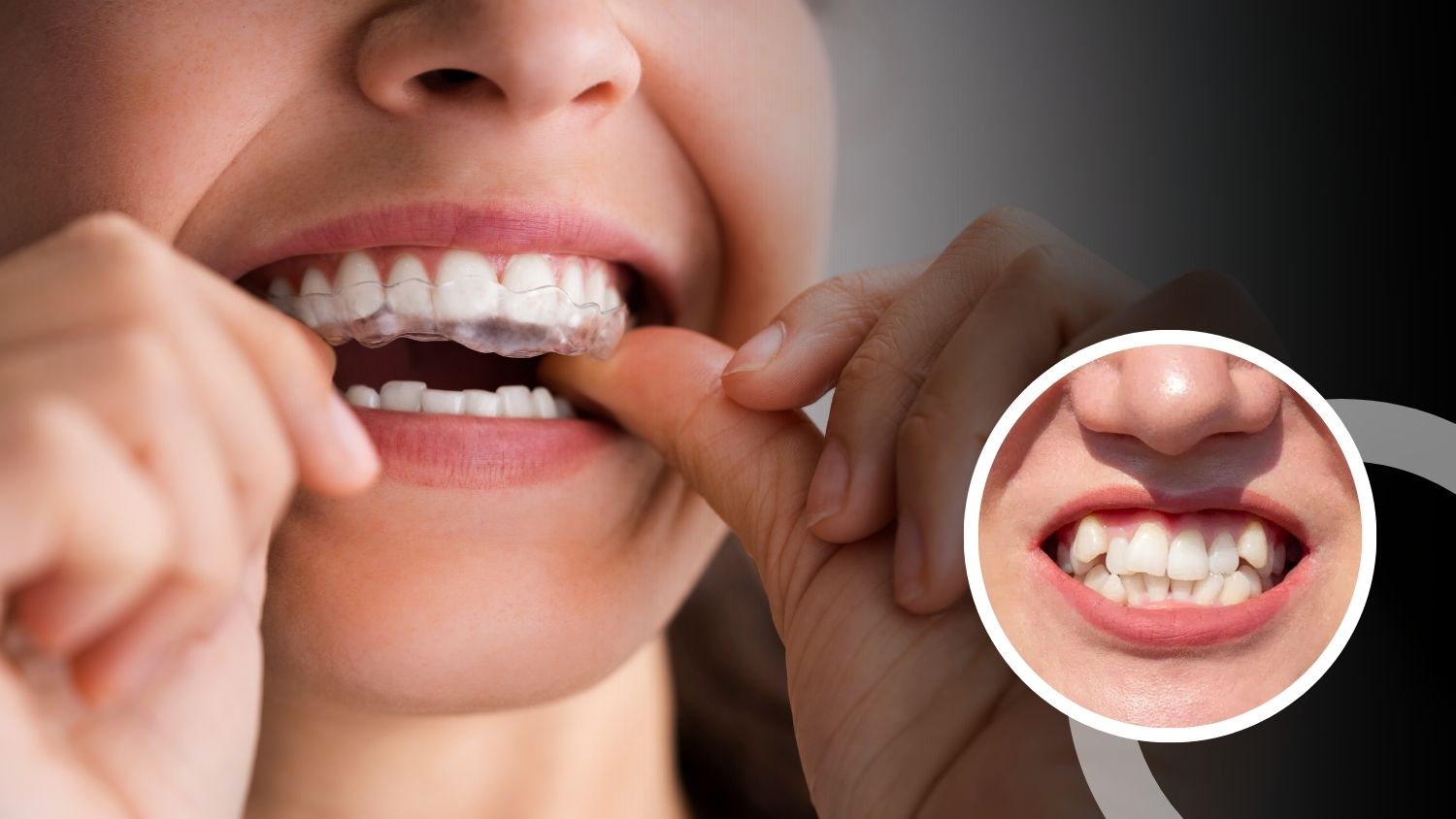 Teeth Braces in Madurai 