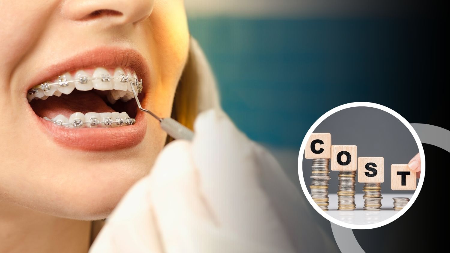 Teeth Clip Cost in Madurai 