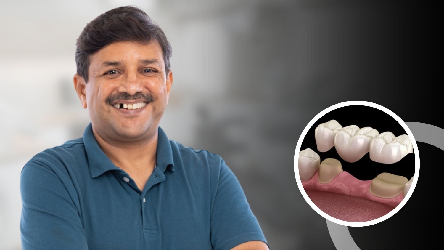 Teeth Replacement in Madurai