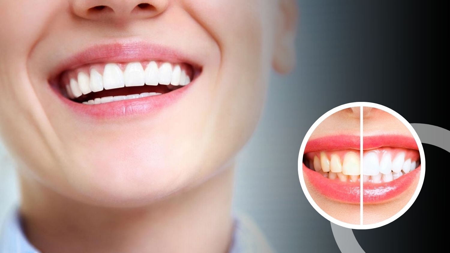 Teeth Whitening Cost in Madurai