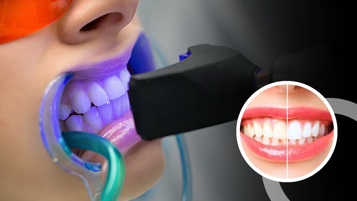 Teeth Whitening Treatment in Madurai, Dental Clinic in Madurai
