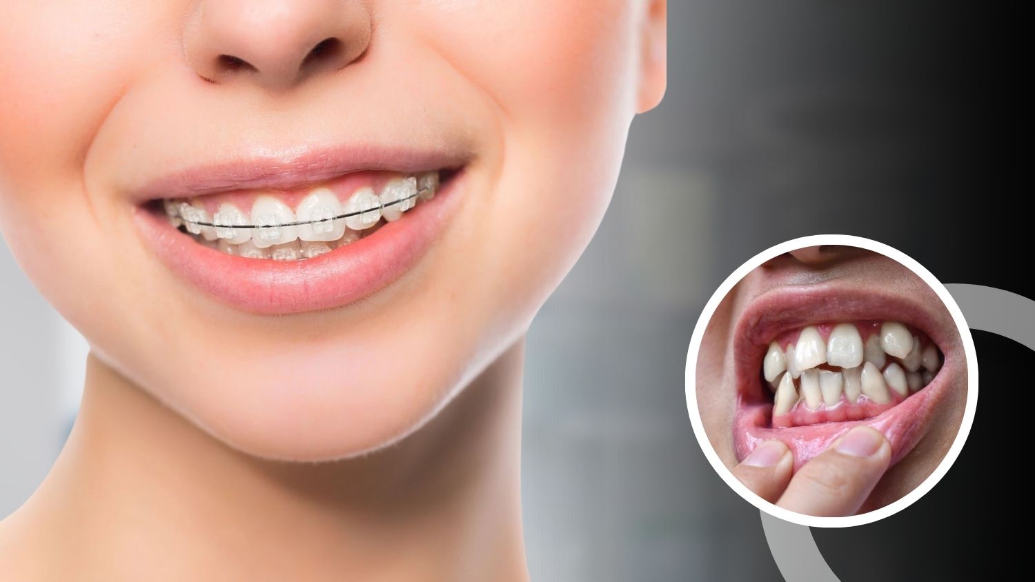 Tooth Clip Treatment in Madurai