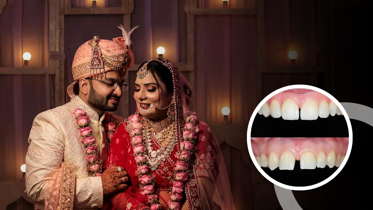 Wedding Smile Packages at SRM Dental Clinic