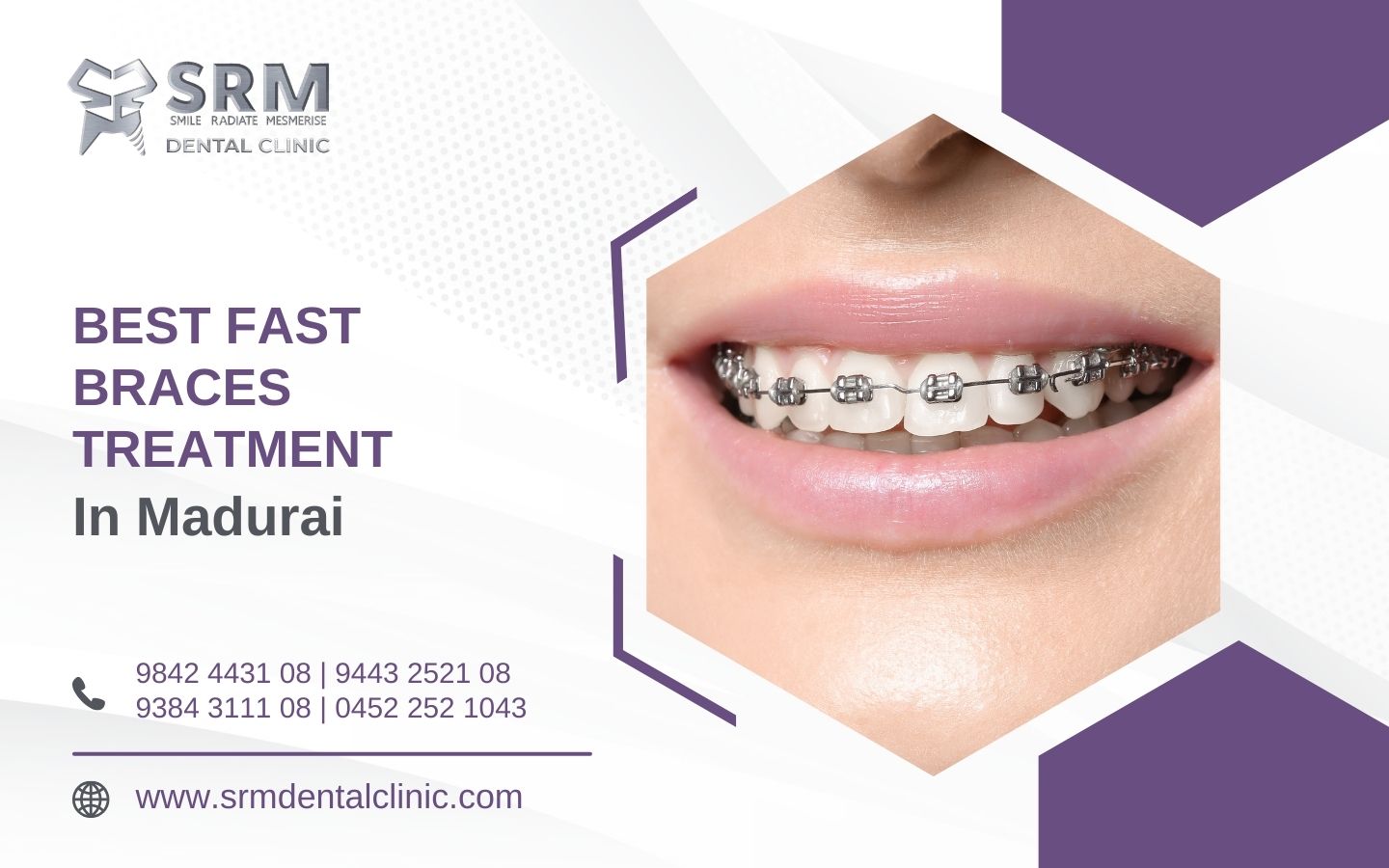 Best Fast Braces Treatment in Madurai