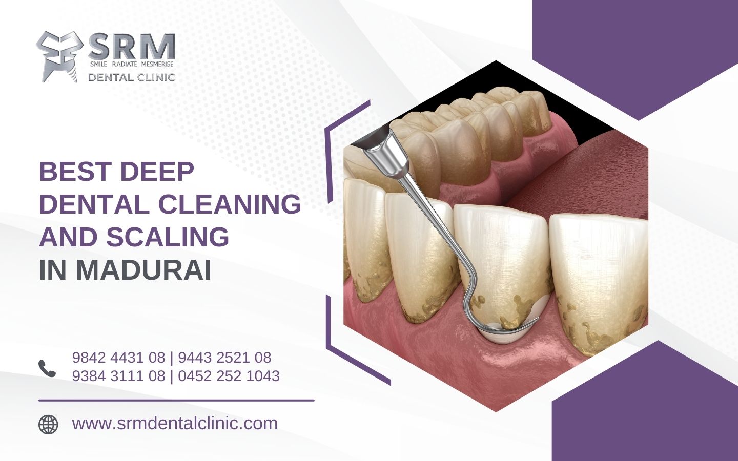 Deep Dental Cleaning and Scaling Madurai