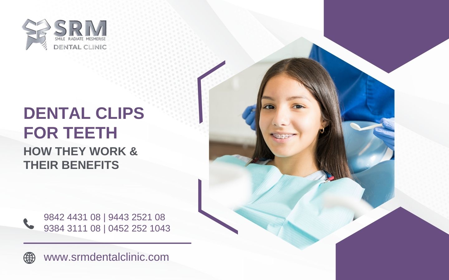 dental clips for teeth