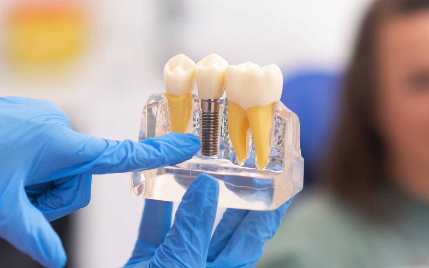 Dental Implants in Madurai