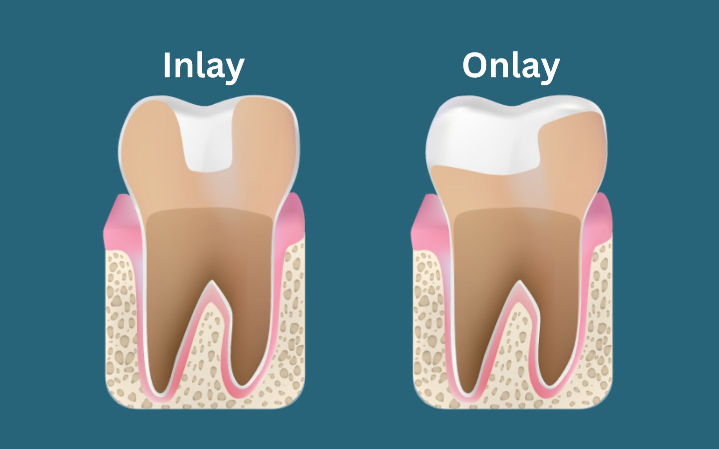 Dental Inlays and Onlays Madurai