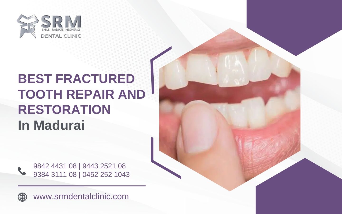 Fractured Tooth Treatment and Restoration in Madurai