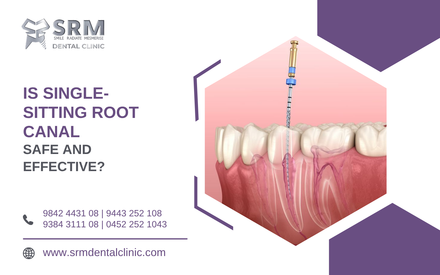 Is Single-Sitting Root Canal Safe and Effective?
