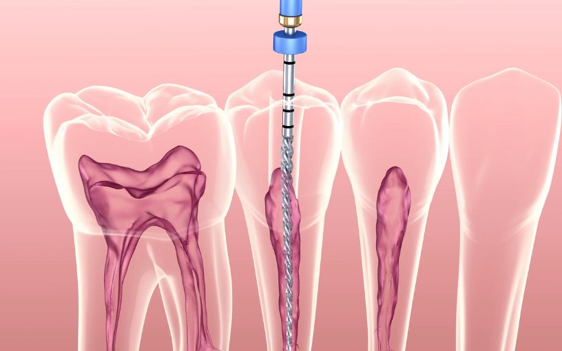 Root Canal Treatment in Madurai