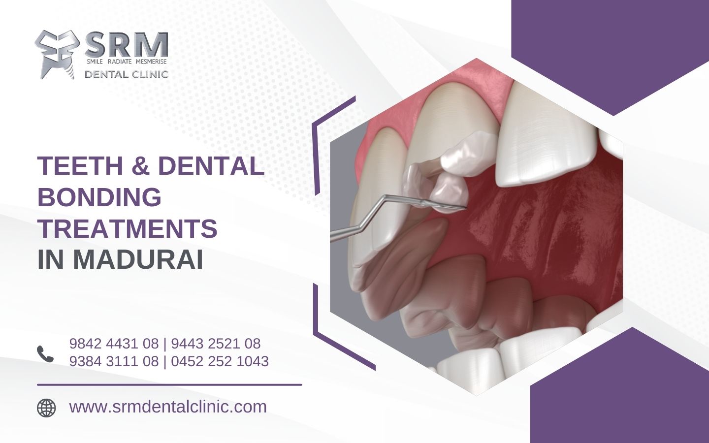 Teeth Dental Bonding Treatment Hospital in Madurai