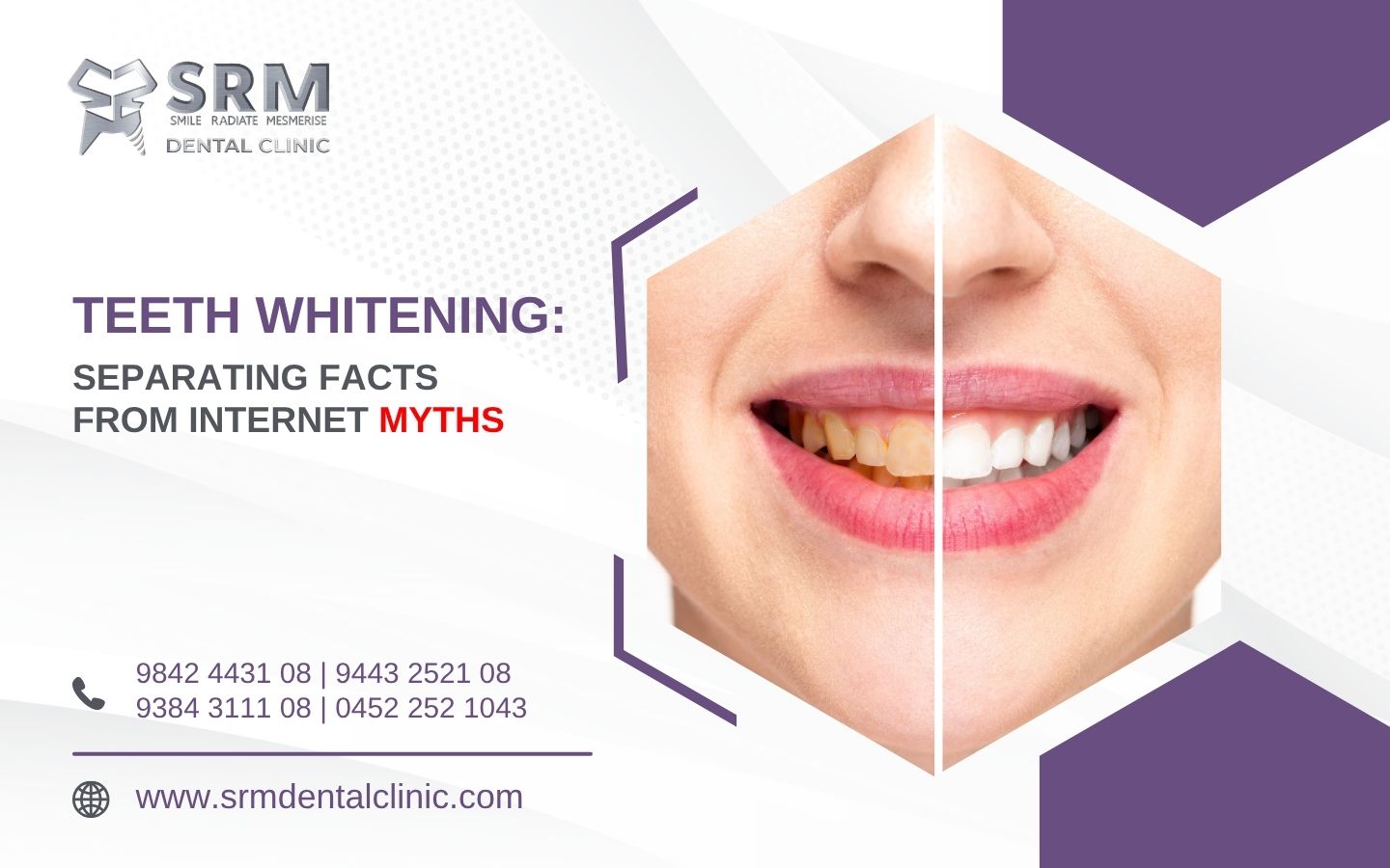 Teeth Whitening in madurai