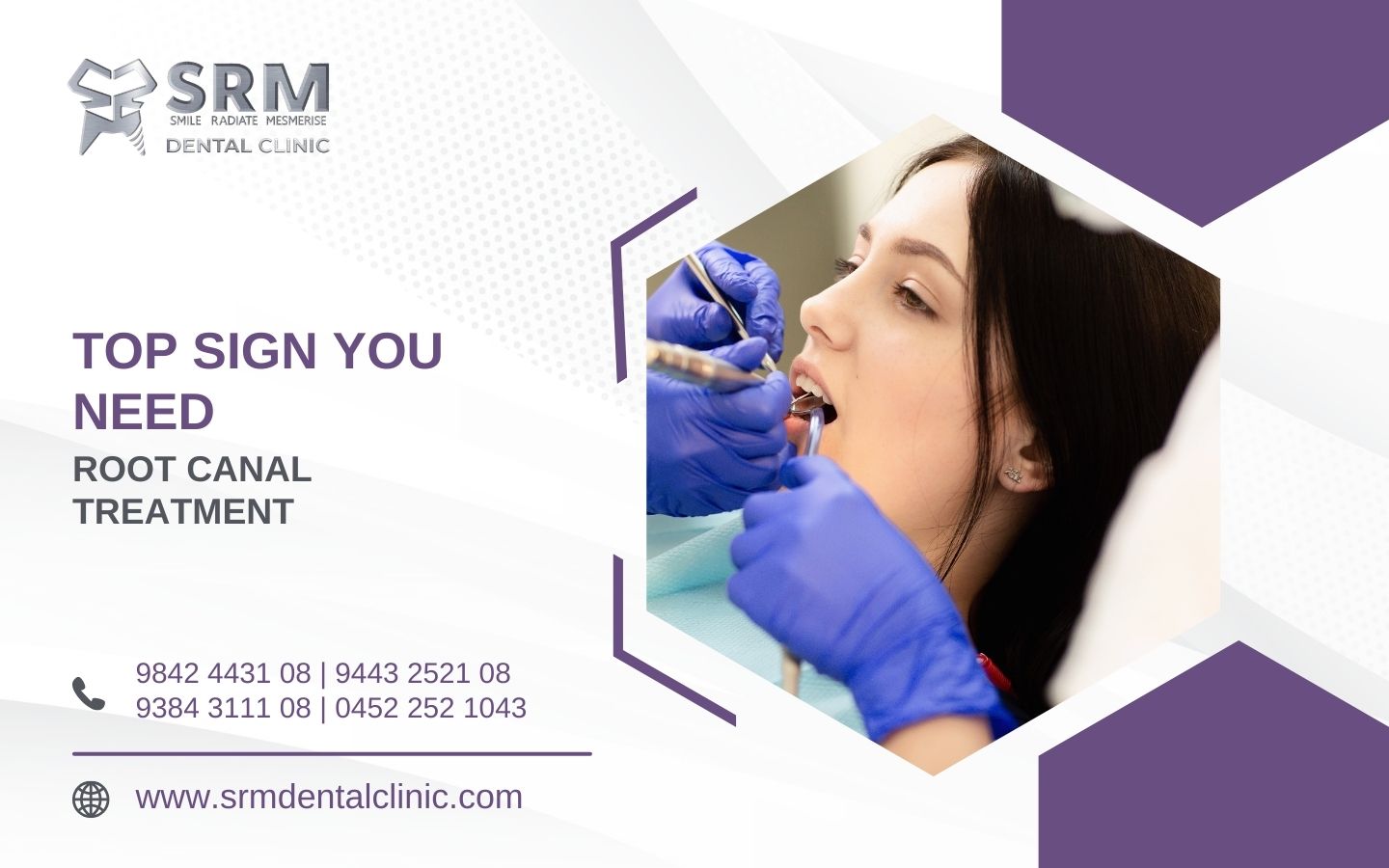 top signs you need root canal treatment