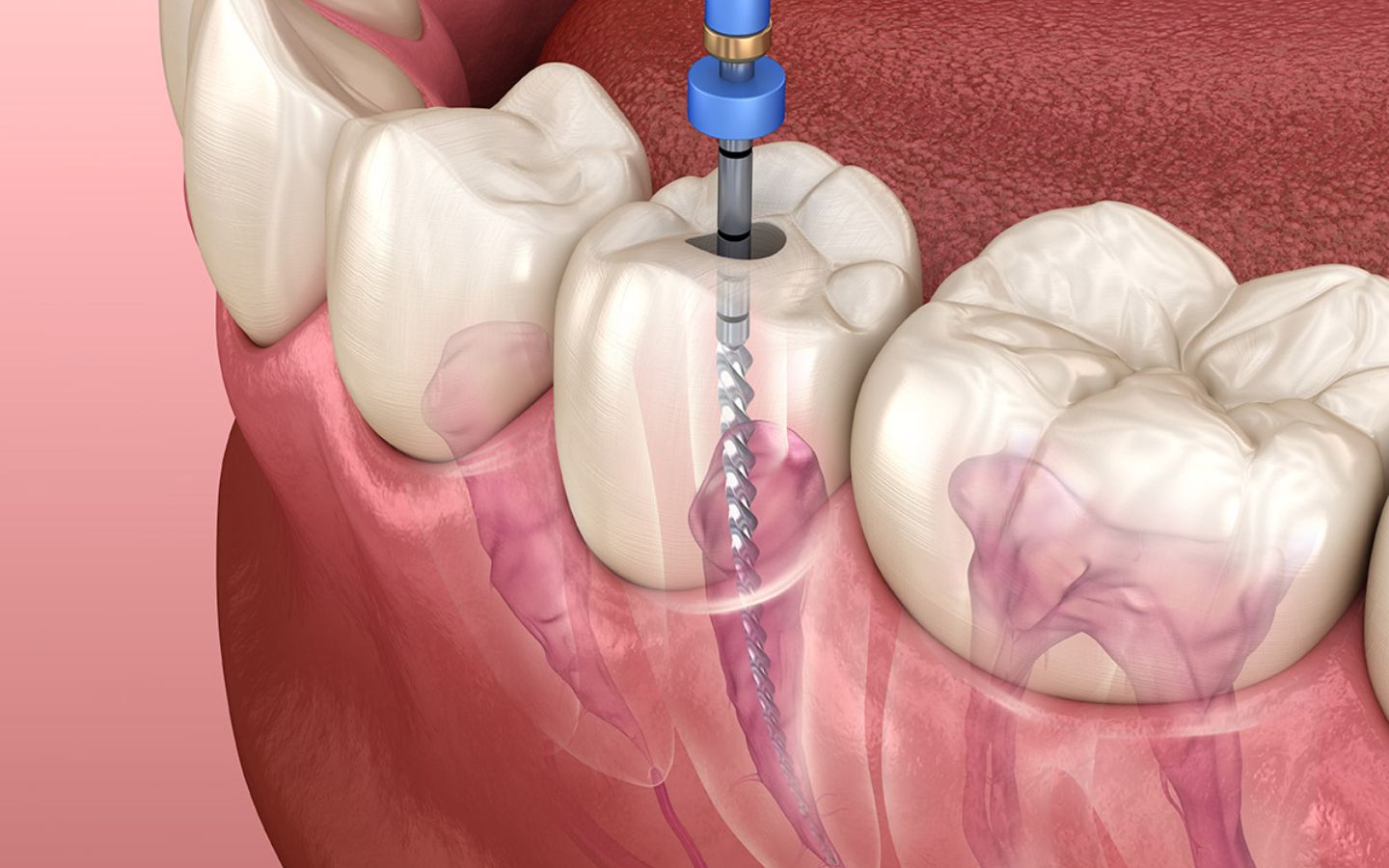 What is the Cost of a Root Canal Treatment