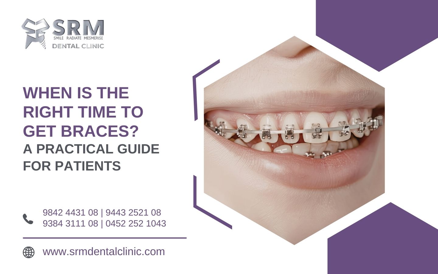 When Is the Right Time to Get Braces? A Practical Guide for Patients